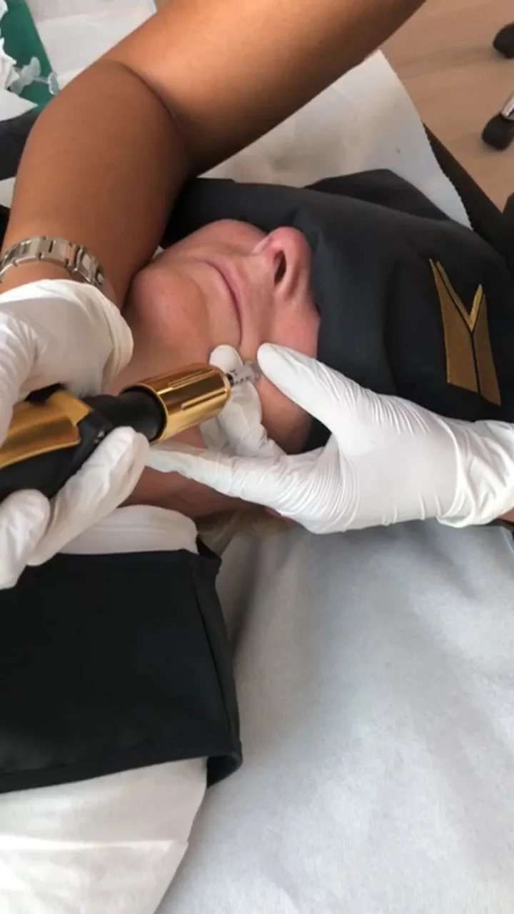 Nadelfreie Hyaluron-Behandlung mit dem IRI® Filler-System in der Nahaufnahme