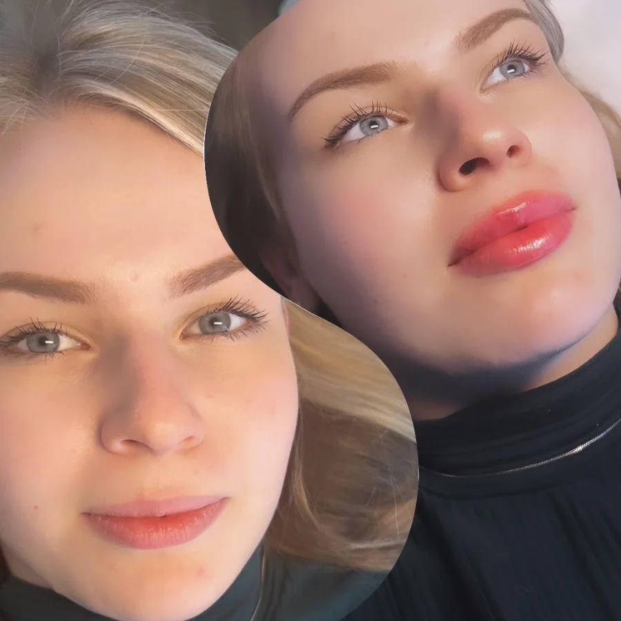 Vorher/Nachher: sichtbare kosmetische Aufpolsterung der Lippen mit dem IRI® Filler-System