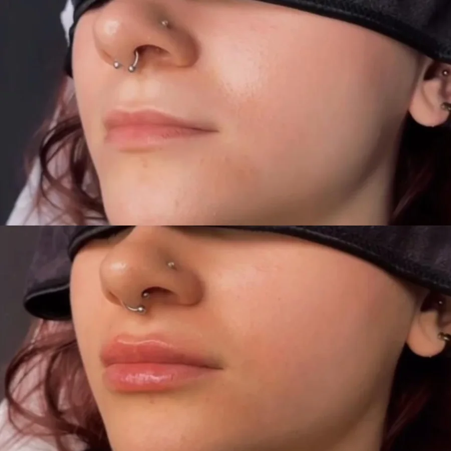 Vorher/Nachher: natürlicher Volumenaufbau der Lippen, direkt nach der Behandlung
