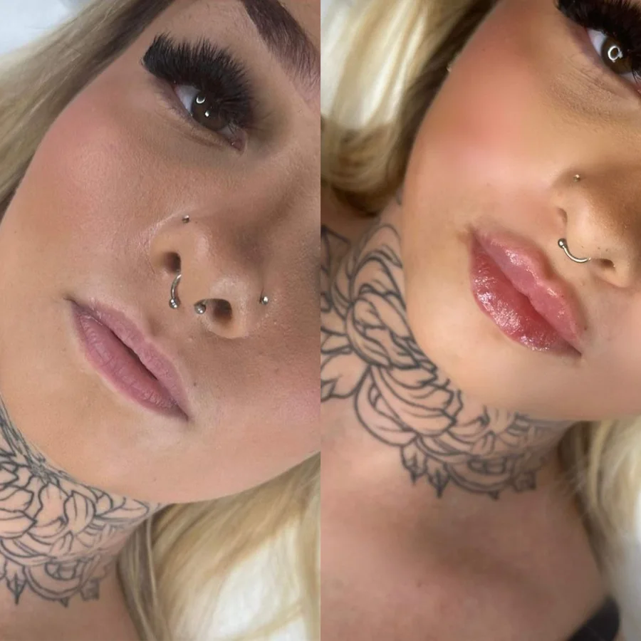 Vorher/Nachher: definierte Lippenkontur und sichtbares Volumen nach der kosmetischen Behandlung